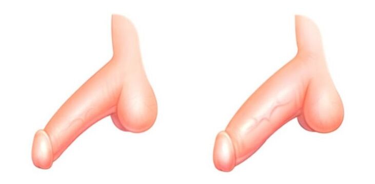 Penis vor und nach der Vergrößerung